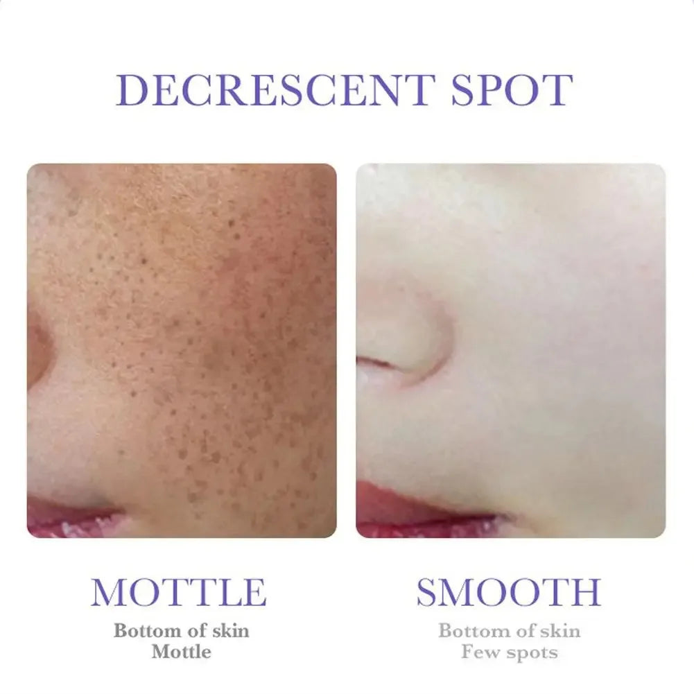 Freckle Removing Cream